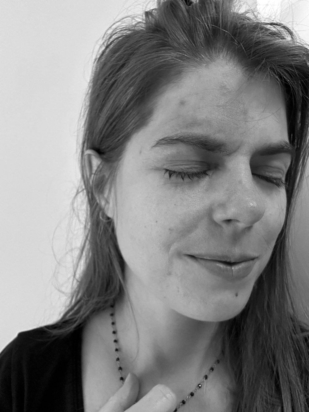 Kelly with her eyes closed, the shingles rash visible around her eye and forehead